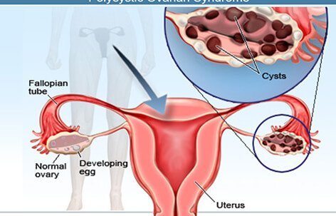ovarian-cysts-s3-cysts-vivix-shaklee ovarian-cysts-s3-cysts-vivix-shaklee